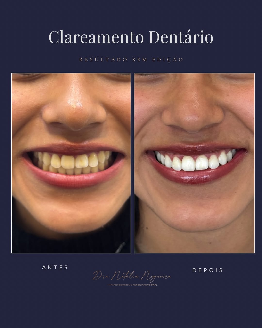 Clareamento Dental (antes e depois)